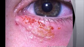 How to Get Rid of Herpes Naturally - Herpes Cure Tips
