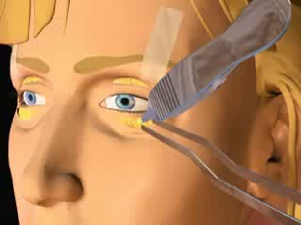 Blépharoplastie :Chirurgie esthétique des paupières en Tunisie