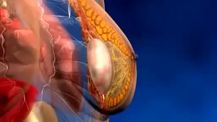 Augmentation mammaire en Tunisie : Pose d'implants