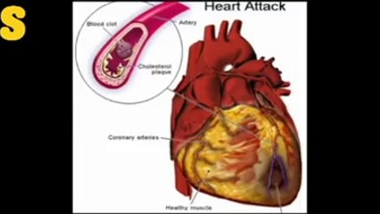 How to avoid a heart attack