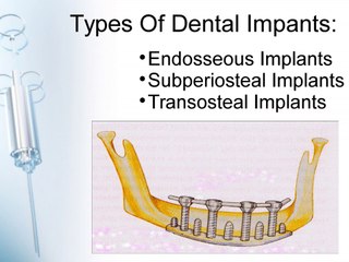 What Are Dental Implants