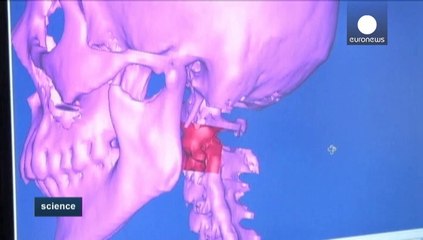 Çin'de 3D omurilik nakli başarıyla sonuçlandı