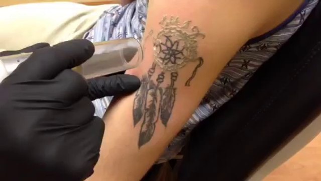 IMG 3272 - Skin Factory Laser Tattoo Removal