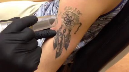 IMG 3272  - Skin Factory Laser Tattoo Removal