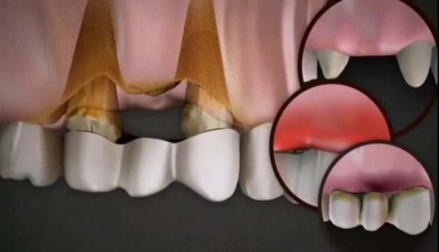 Dental Implants Laguna Niguel CA,Dental Implants Laguna Niguel