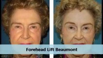 My Movie3Facial Plastic Surgery of Beaumont Forehead Lift Treatment