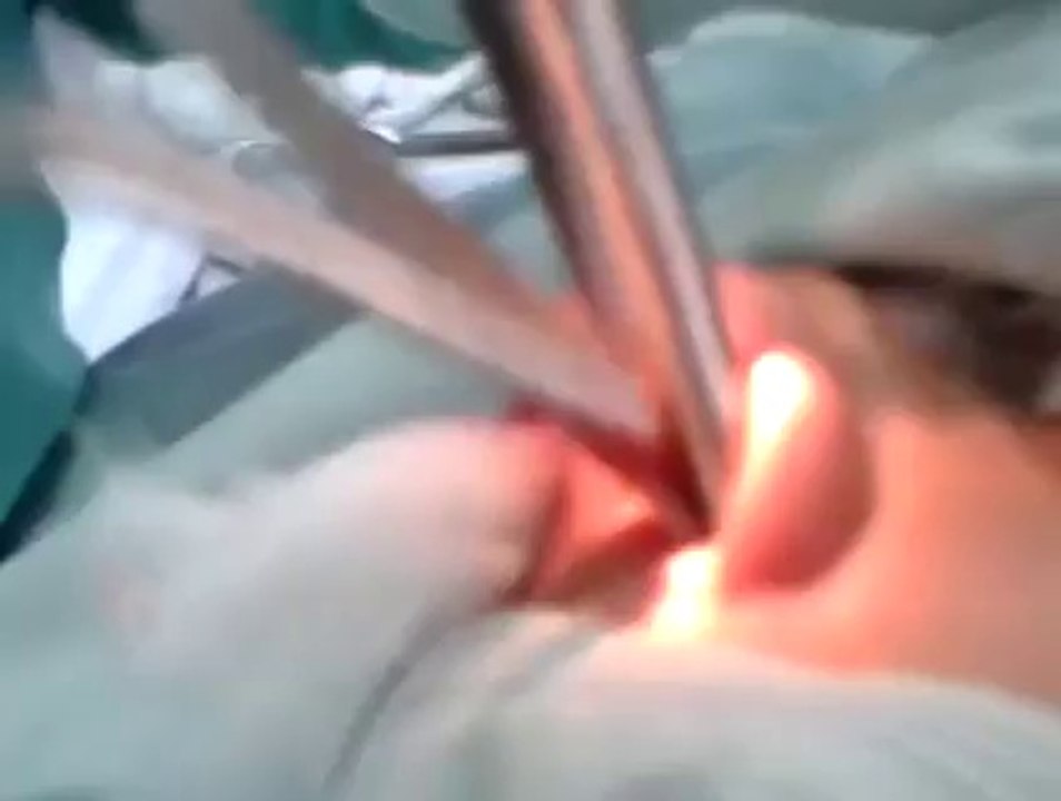 yaqoob huma mughal, bilateral partial inferior turbinectomy, kopt khawaja saeed, 29.11.13