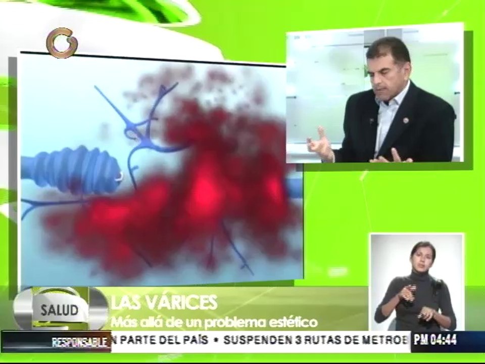 Cato: Las varices "Es una enfermedad crónica sin cura"