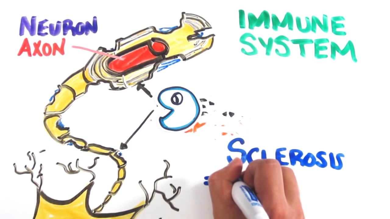 Multiple Sclerosis