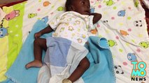 Parasitic twin - Baby with 4 arms and 4 legs born in Uganda undergoes corrective surgery.