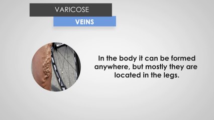 Basic Information about Spider Veins and Varicose Veins