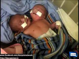 Dunya News - Baby with two heads born in private hospital Karachi