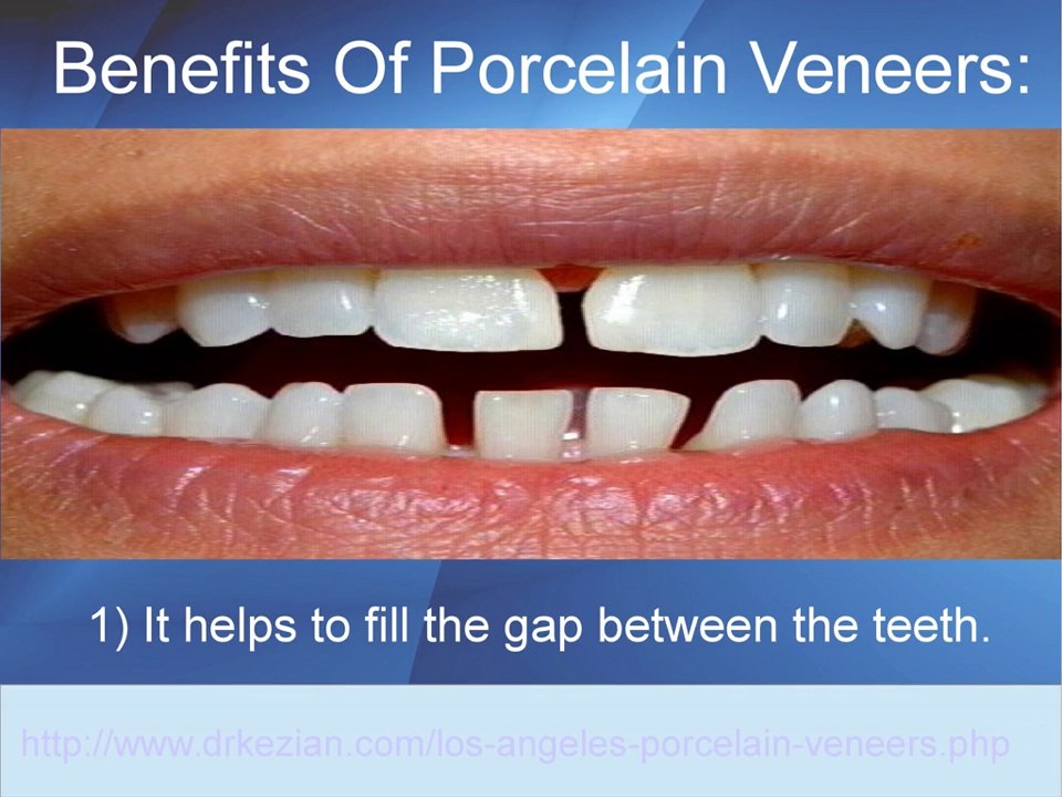 What Are Porcelain Veneers And Their Benefits