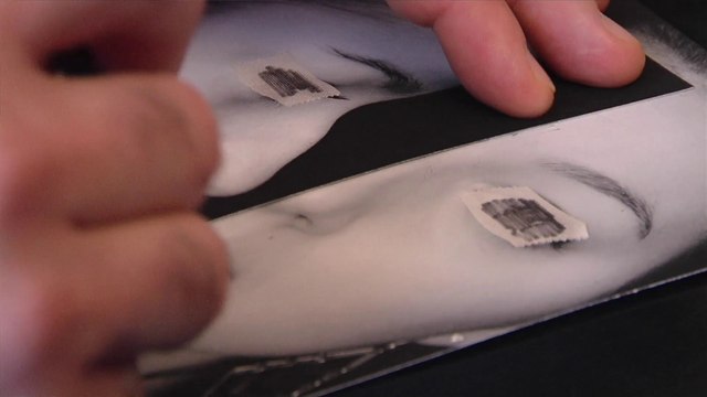 L'acte de chirurgie de la rhinoplastie