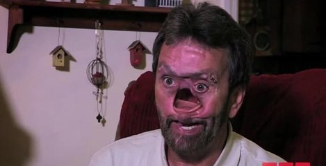 Cet homme a vécu avec un trou au milieu du visage