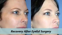 Kleinman Plastic Surgery Eyelid Lift Procedure