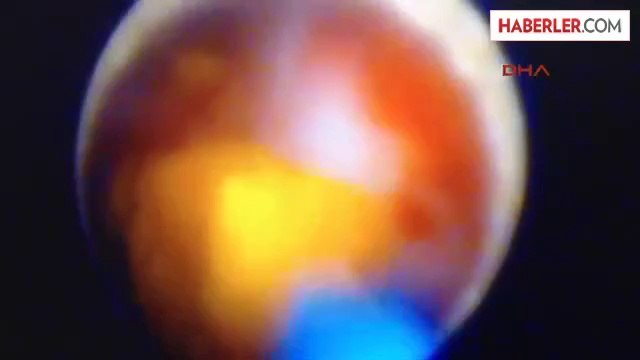 Kars Kaü'de İlk Kez Kapalı Böbrek Taşı Ameliyatı Yapıldı