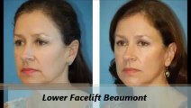 Facial Plastic Surgery of Beaumont Lower Facelift Procedure