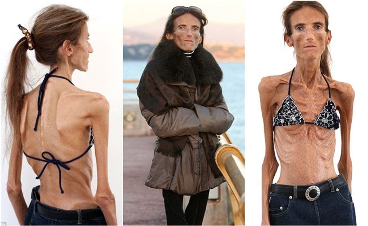 La Femme La Plus Maigre Du Monde Ne Pese Que 25 Kilos Video Dailymotion