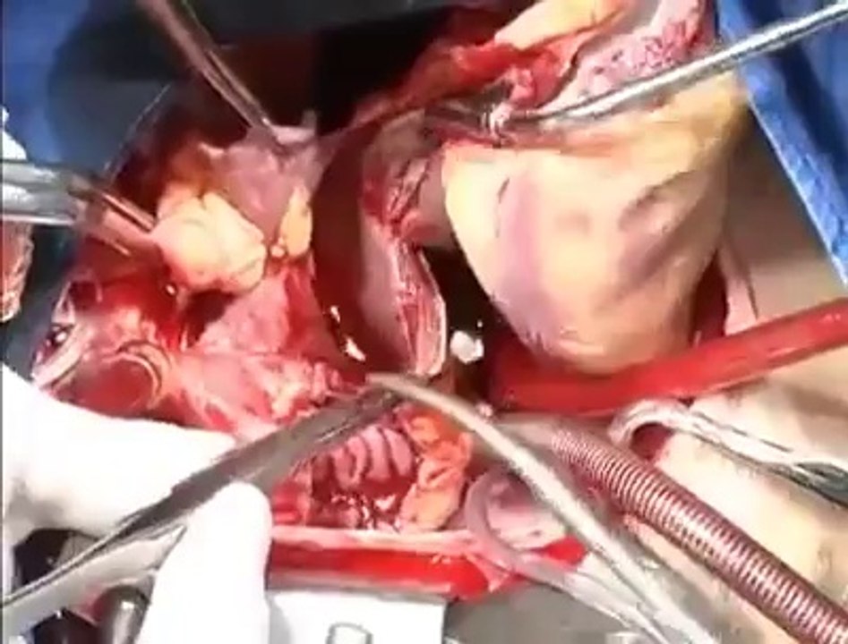 HEART BYPASS OPERATION LIVE WATCH VIDEO