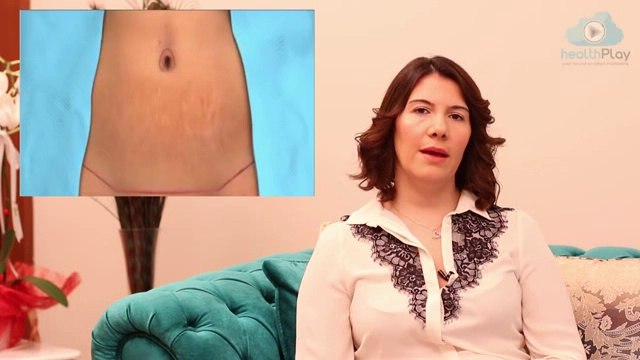 Op.Dr. Ayşegül Sivri Karın Germe