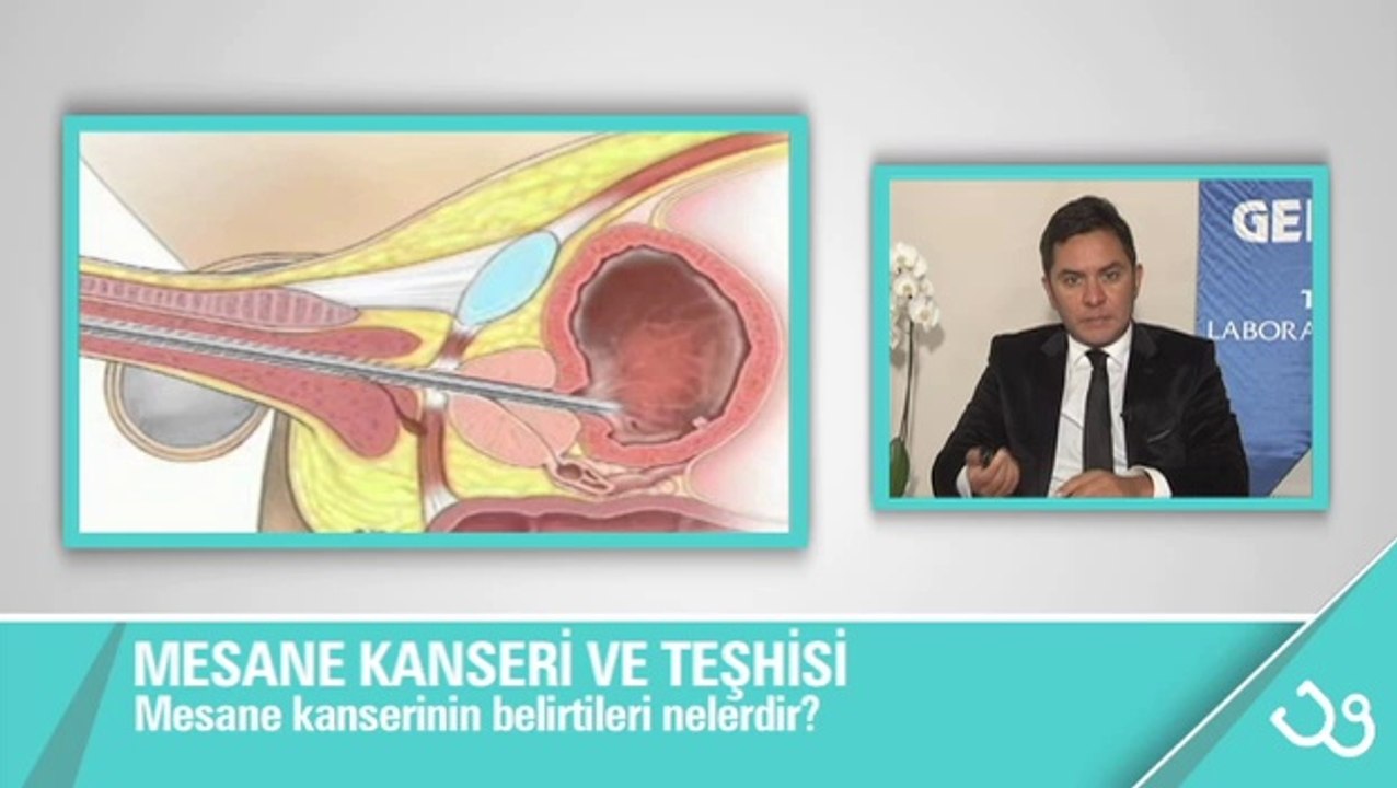 Mesane kanserinin belirtileri nelerdir