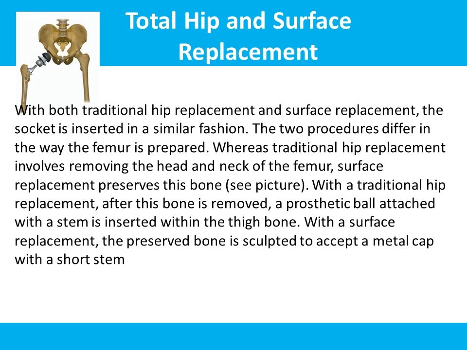 Hip resurfacing surgery in Delhi