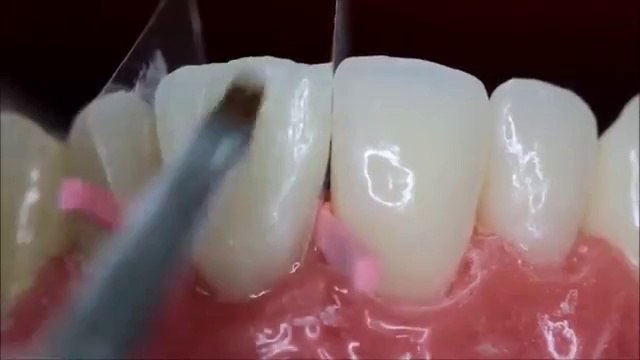 Реставрация зуба. Как это происходит.