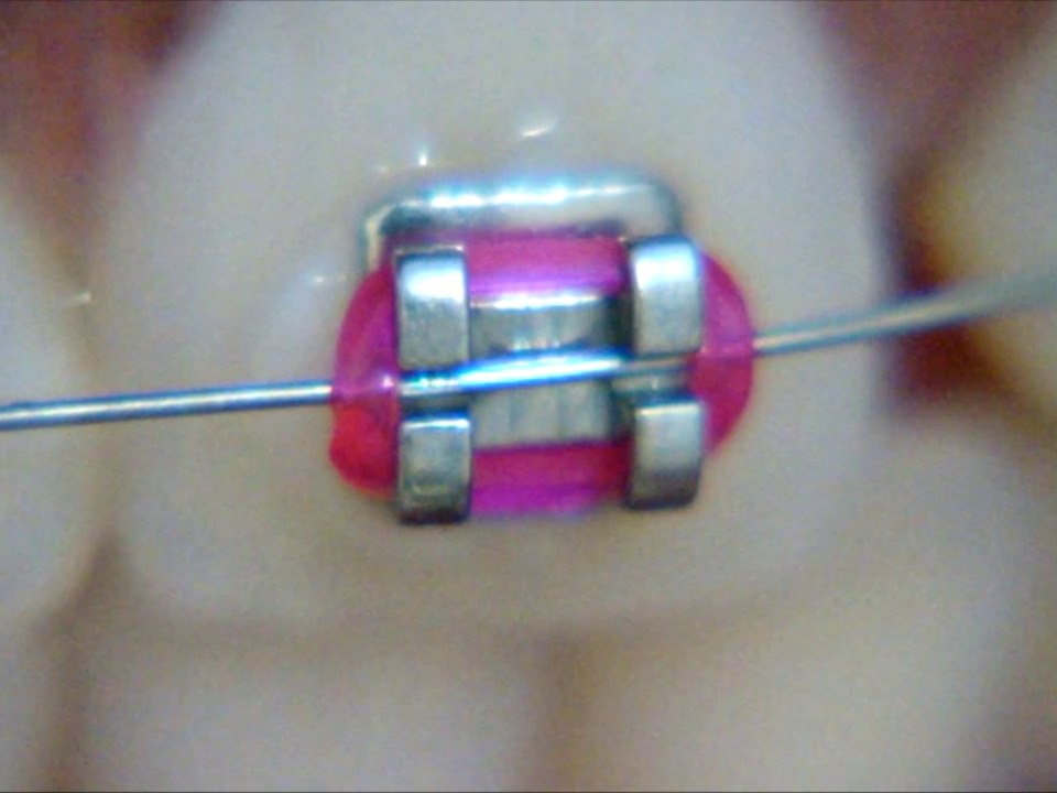 Procedimiento para la sustitución de los elásticos ortodónticos