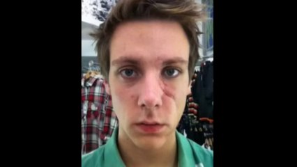 Selfie time-lapse video of slash victim's face healing