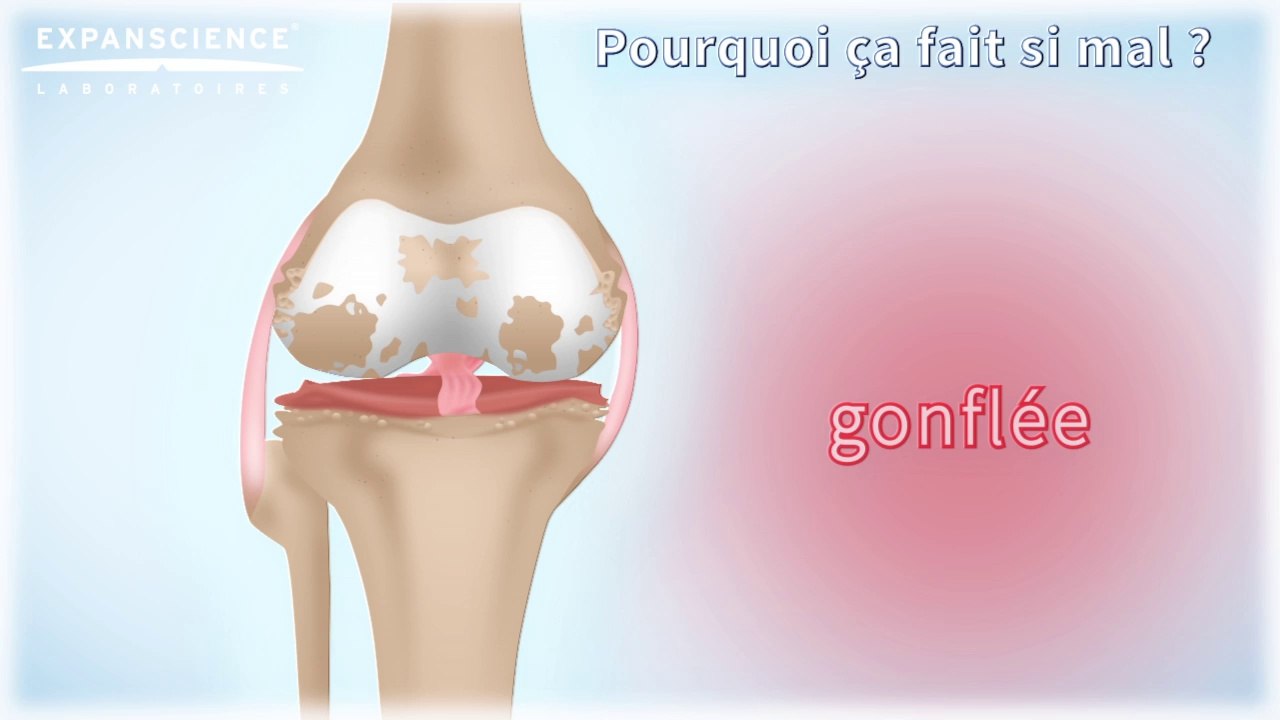 Comprendre l’arthrose du genou | Arthrolink