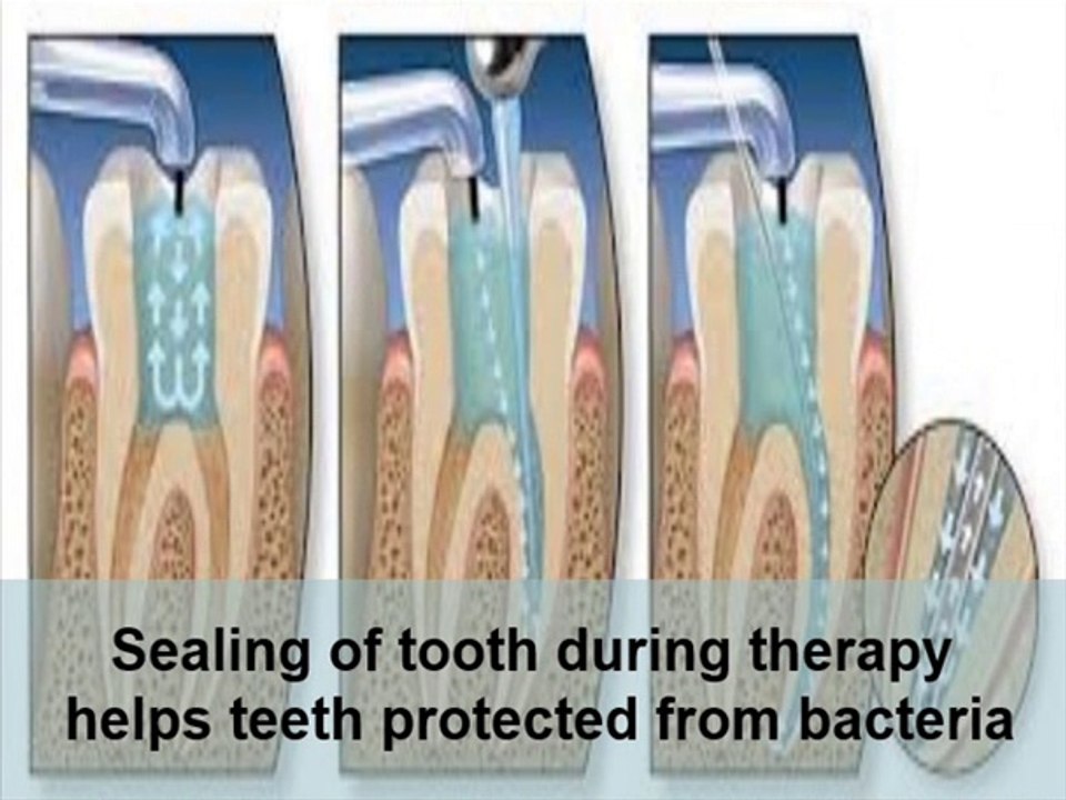 Root Canal Therapy Advantages