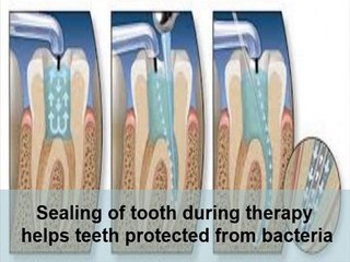 Root Canal Therapy Advantages
