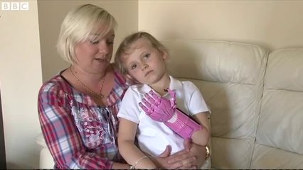 3D printed hand first for Inverness girl