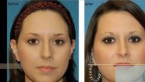 Facial Plastic Surgery of Beaumont Rhinoplasty Procedure