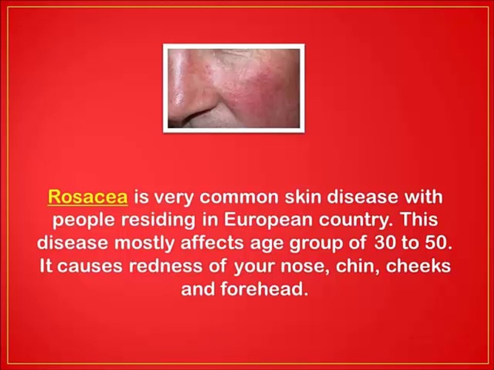 How To Cure Rosacea Redness Naturally - natural treatment for rosacea