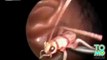 Bug in ear - Indian guy has kraken pulled out of his ear by doctor.