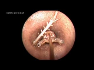 Un medecin retire un insecte de l'oreille d'une personne