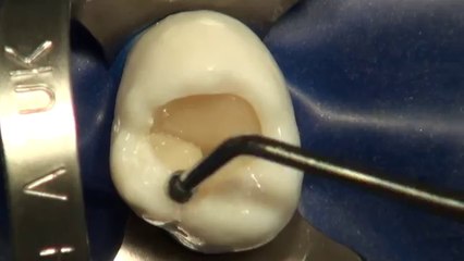 Composite Clase - Class I Molar Superior - Ultradent Amelogen Plus (A2 - EN)
