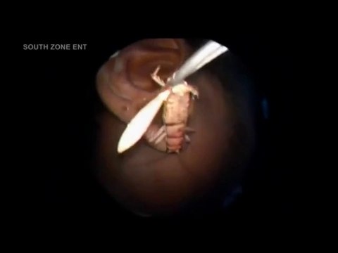 Insecte coincé dans l'oreille