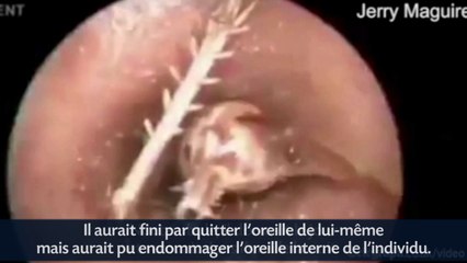 Un criquet retiré d'une oreille par un médecin