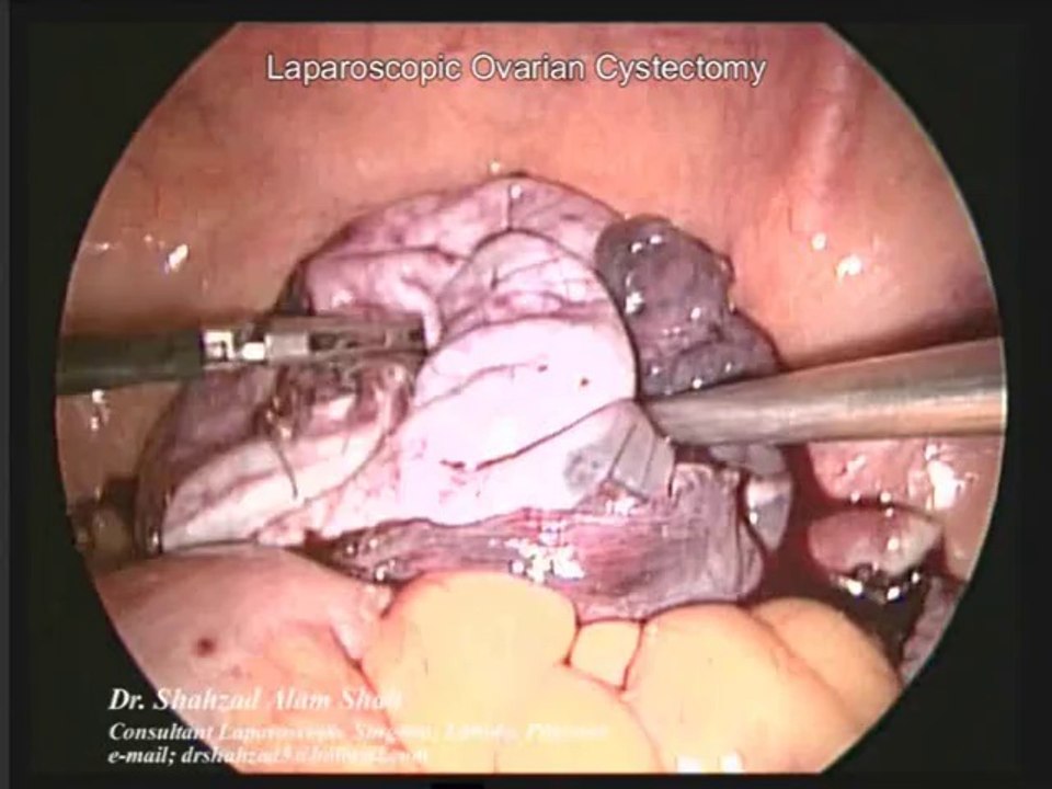 Laparoscopic Ovarian Cystectomy: Ovary removal Surgery
