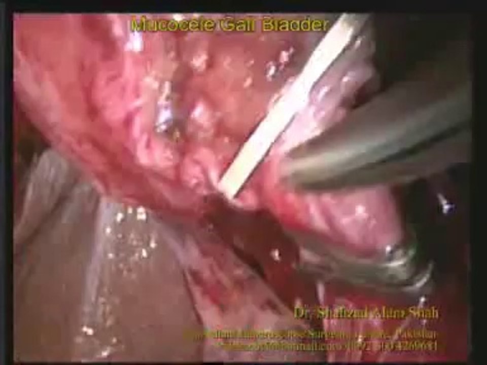 Mucocele Lap Chole: Gall Bladder Removal Surgery