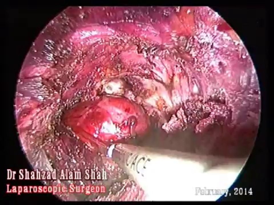 Endoscopic Thyroidectomy: ETAT