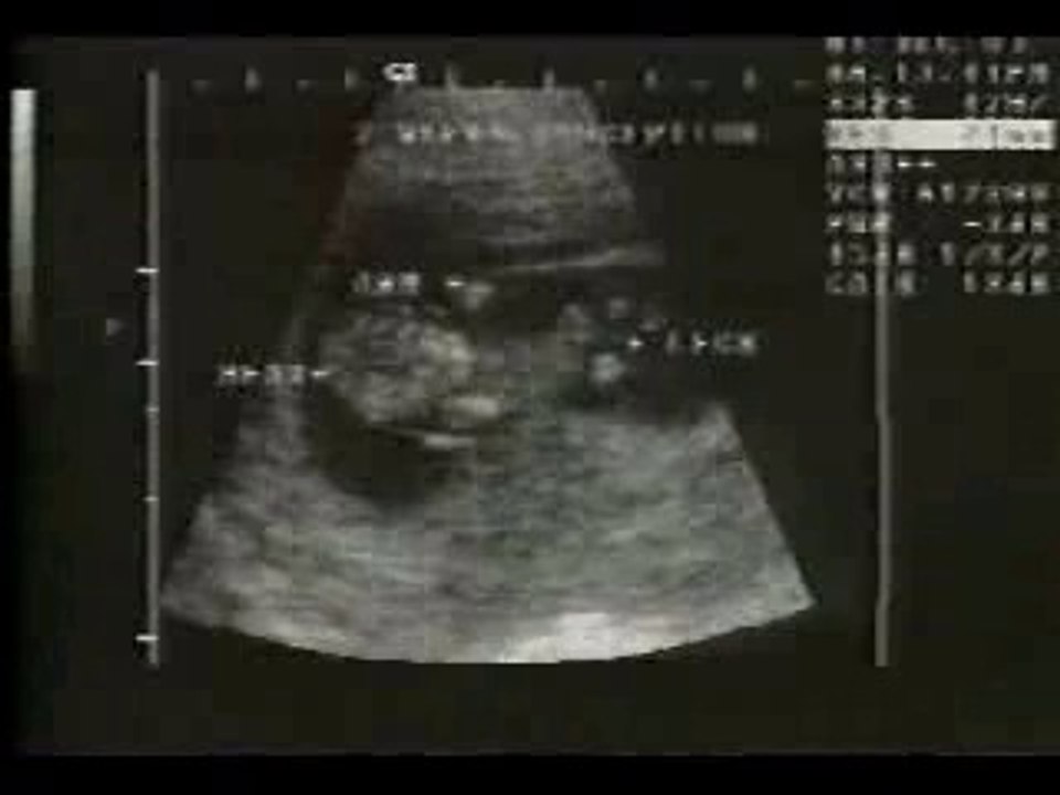 ECOGRAFIA DE EMBRION DE 7 SEMANAS