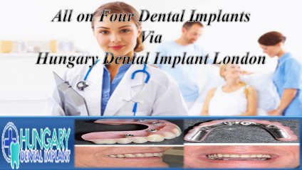 All on Four Dental Implants via Hungary Dental Implant London