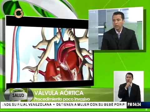 Cambio de válvula aórtica sin intervención prolonga vida de los pacientes