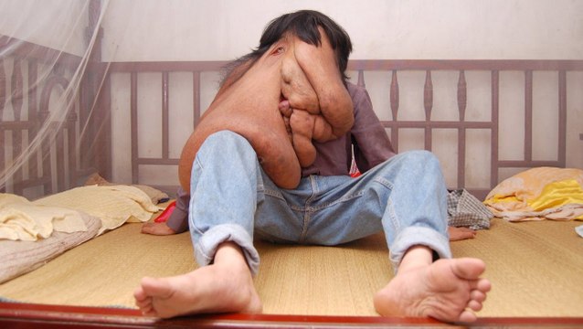 Elephant Man Chinois : Huang Chuncai (Reportage)