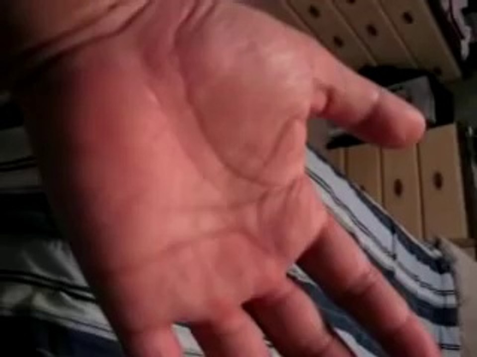 Hives Urticaria What do they look like and what is cure see link