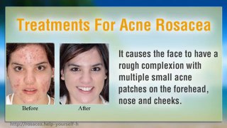 Treatments For Acne Rosacea